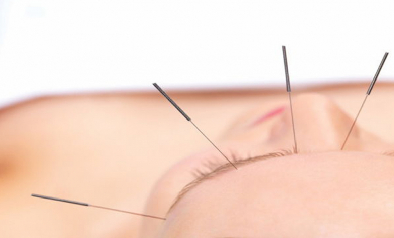 Migren İçin Akupunktur Tedavisi Mümkün Mü?